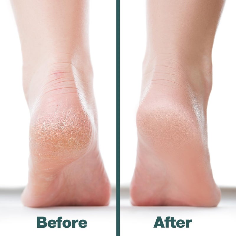 Probelle Double Sided Multidirectional Nickel Foot File Callus Remover - Immediately Reduces calluses and Corns to Powder for Instant Results  Safe Tool (Dark Grey) - Image 5